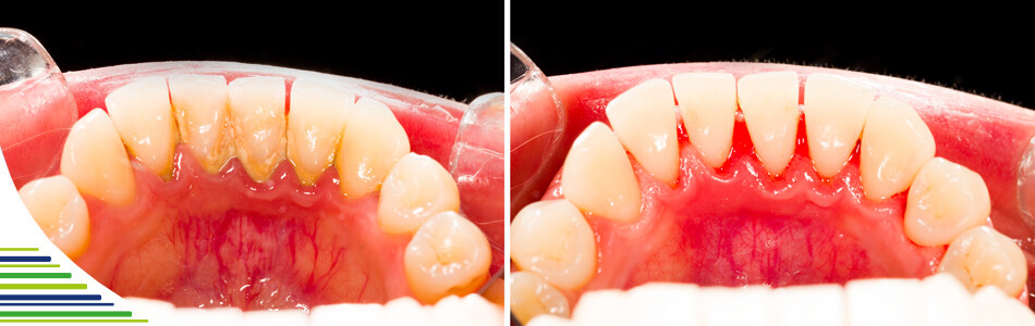 Zubný kameň – príčiny vzniku a prevencia