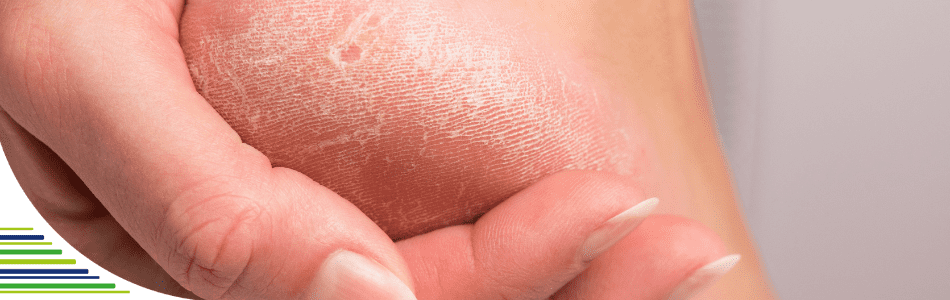 Ako sa zbaviť zhrubnutej kože