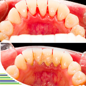 Zubný kameň – príčiny vzniku a prevencia