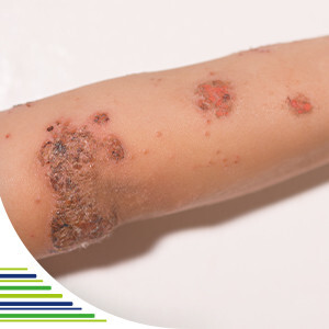 Impetigo – čo robiť s nákazlivou bakteriálnou infekciou kože?