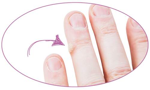 Kolodium forte bradavice