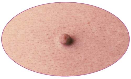Kolodium forte fibrom